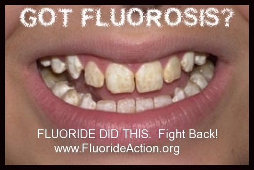 Leugens in beeld.. Een overdosis fluoride beschermt het gebit helemaal NIET! Integendeel, tandglazuur en tanden worden zo hard, dat ze broos worden!
