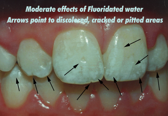 tooth fluoride dosis