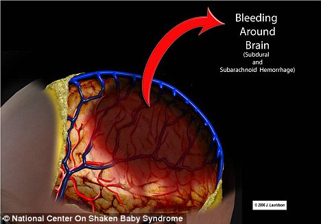 Tja, waardoor zou baby-hersenen nog meer kunnen gaan bloeden, dan door mishandeling van ouders..?